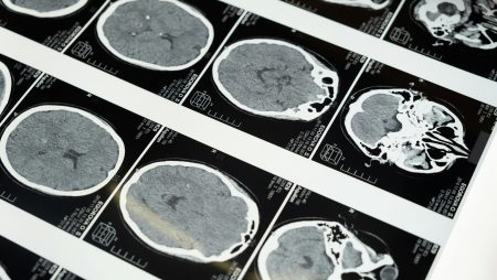 Poker, cosa succede nel nostro cervello?