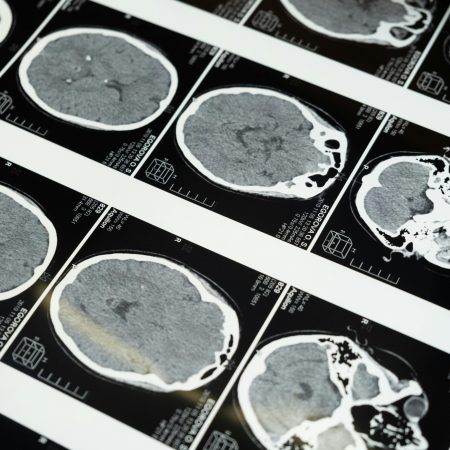 Poker, cosa succede nel nostro cervello?