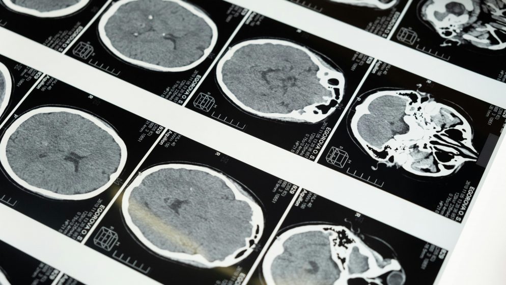 Poker, cosa succede nel nostro cervello?